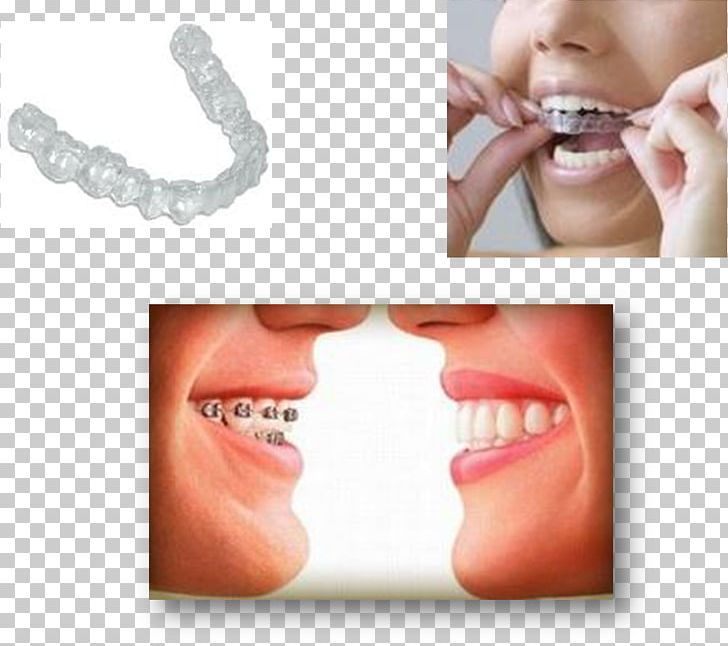 Tooth Dental Braces Orthodontics Crossbite Dentist PNG, Clipart, Animal Bite, Cheek, Chin, Cosmetic Dentistry, Crossbite Free PNG Download