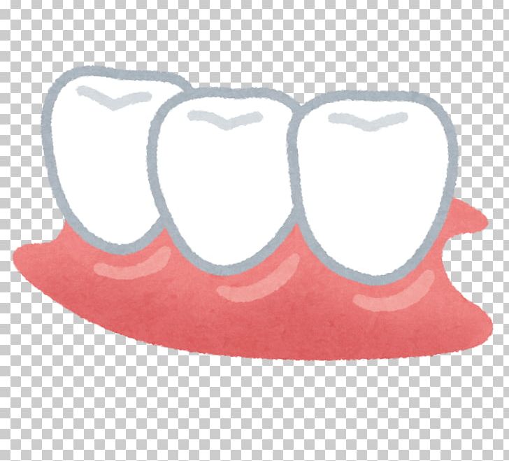 Dentures Dentist Tooth Removable Partial Denture Therapy PNG, Clipart, Dental Calculus, Dental Hygienist, Dental Implant, Dentist, Dentistry Free PNG Download