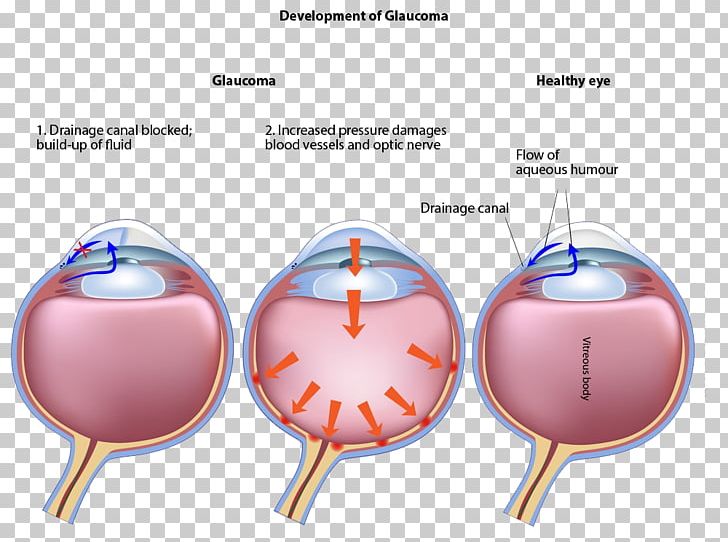 Glaucoma Laser Surgery Eye Disease Ophthalmology PNG, Clipart, Disease, Ear, Eye, Eye Surgery, Glaucoma Free PNG Download
