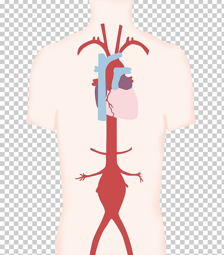 Aneurysm Artery Blood Vessel Aorta Thumb PNG, Clipart, Abdominal Aorta, Aneurysm, Aorta, Aortic Aneurysm, Arm Free PNG Download