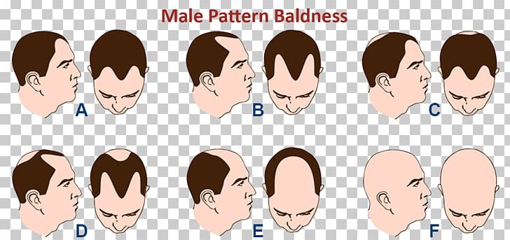 Hair Coloring Pattern Hair Loss Pubic Hair PNG, Clipart, Black Hair, Brown Hair, Capelli, Cartoon, Cheek Free PNG Download