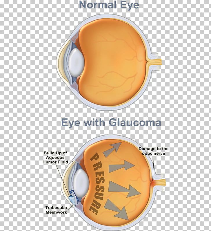 Glaucoma Human Eye Eye Care Professional Optic Nerve PNG, Clipart, Art, Clip, Disease, Ear, Eye Free PNG Download