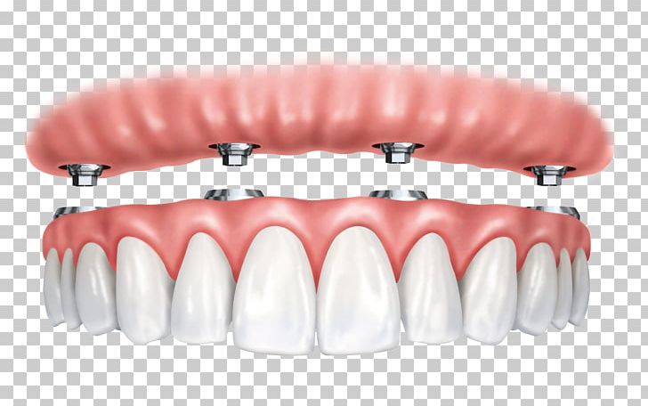 Dental Implant All-on-4 Dentistry Dentures PNG, Clipart, Allon4, All On 4, Dental Arch, Dental Implant, Dental Restoration Free PNG Download