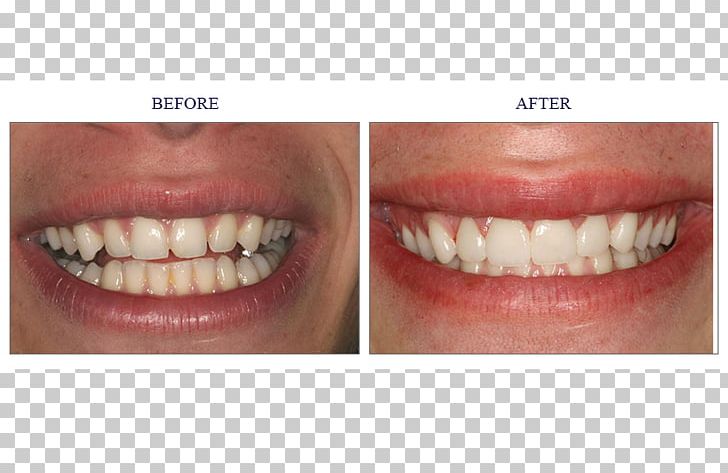 Tooth Veneer Cosmetic Dentistry Crown PNG, Clipart, Chin, Closeup, Cosmetic Dentistry, Crown, Dental Composite Free PNG Download