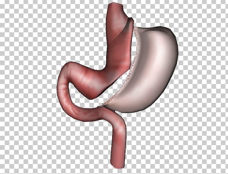 Bariatric Surgery Sleeve Gastrectomy Gastric Bypass Surgery Adjustable Gastric Band PNG, Clipart, Arm, Bariatrics, Bariatric Surgery, Ear, Finger Free PNG Download