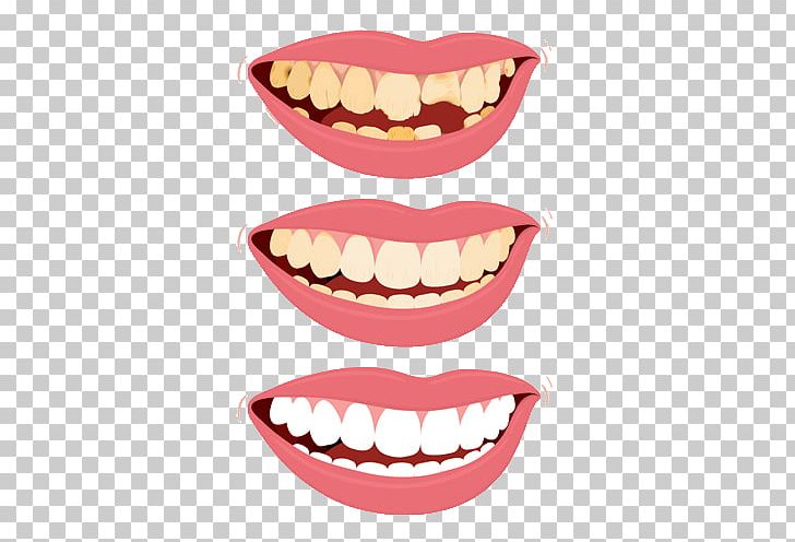 Human Tooth Food Tooth Decay PNG, Clipart, Dandelions, Dentist, Dentition, Drawing, Food Free PNG Download