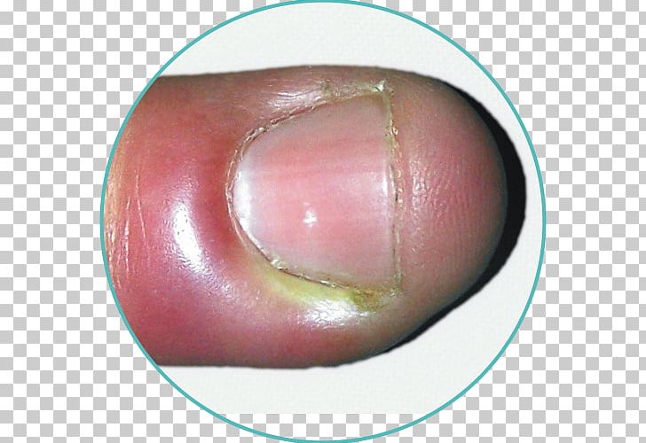 Nail Paronychia Inflammation Folliculitis Infection PNG, Clipart, Acne, Bacteria, Body, Body Hair, Closeup Free PNG Download