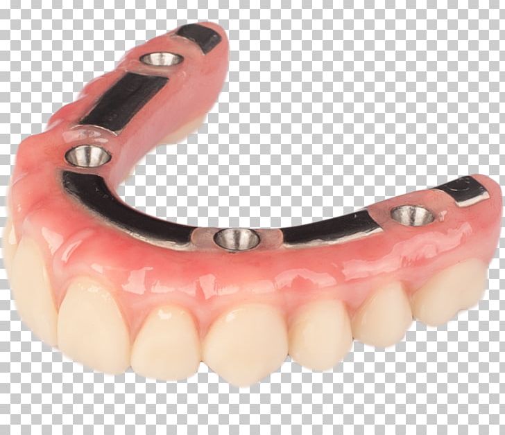 Tooth Dentures Dental Implant Prosthesis PNG, Clipart, Bar, Bridge, Dental Implant, Dental Restoration, Dentistry Free PNG Download