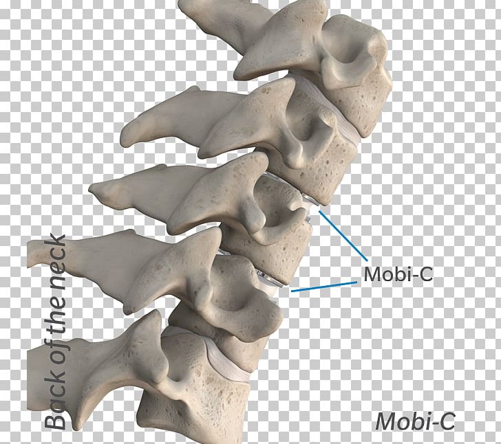 The Cervical Disc Surgery Anterior Cervical Discectomy And Fusion Cervical Vertebrae Intervertebral Disc Arthroplasty PNG, Clipart, Bone, Cervical, Cervical Vertebrae, Dental Implant, Disc Free PNG Download