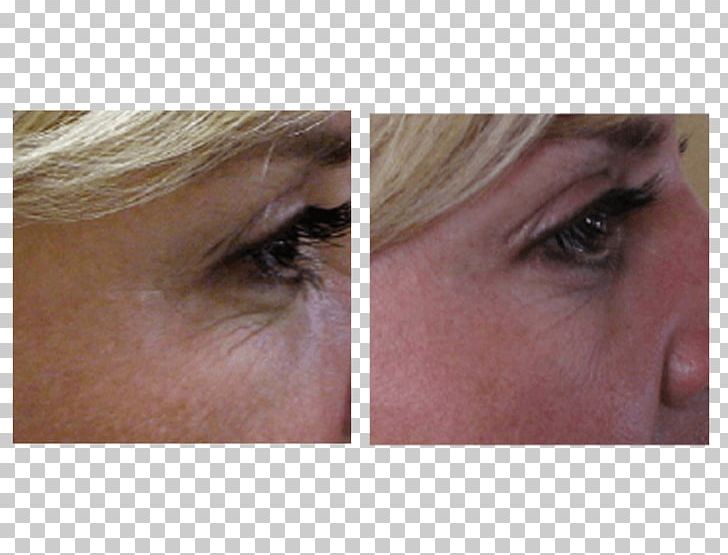 Eyelash Extensions Chin Cheek Forehead Eyebrow PNG, Clipart, Artificial Hair Integrations, Cheek, Chin, Closeup, Closeup Free PNG Download