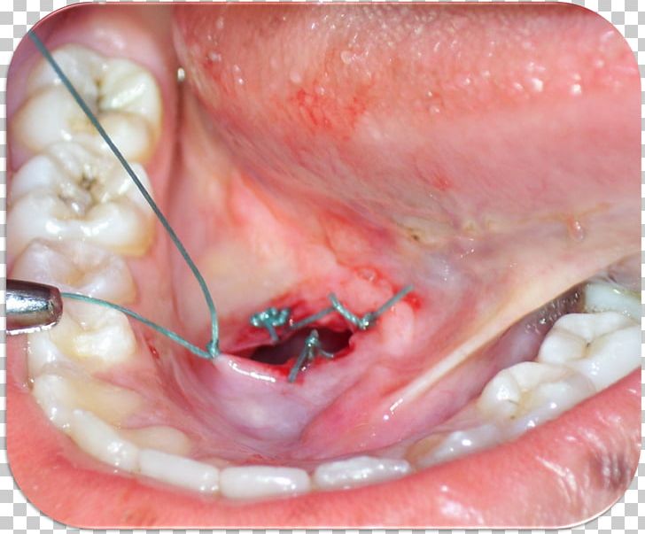 Marsupialization Cyst Ranula Surgery Dentistry PNG, Clipart, Bartholins ...