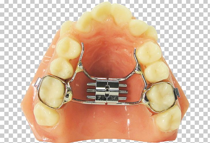 Tooth Orthodontic Technology Orthodontics Dentistry Dental Braces PNG, Clipart, Appliances, Bruxism, Buford, Crossbite, Dental Braces Free PNG Download