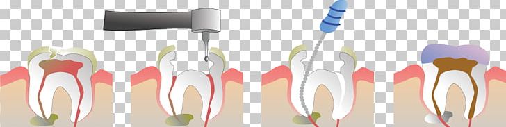 Endodontic Therapy Root Canal Endodontics Pulp Dentist PNG, Clipart, Brush, Canal, Crown, Cutlery, Dental Free PNG Download