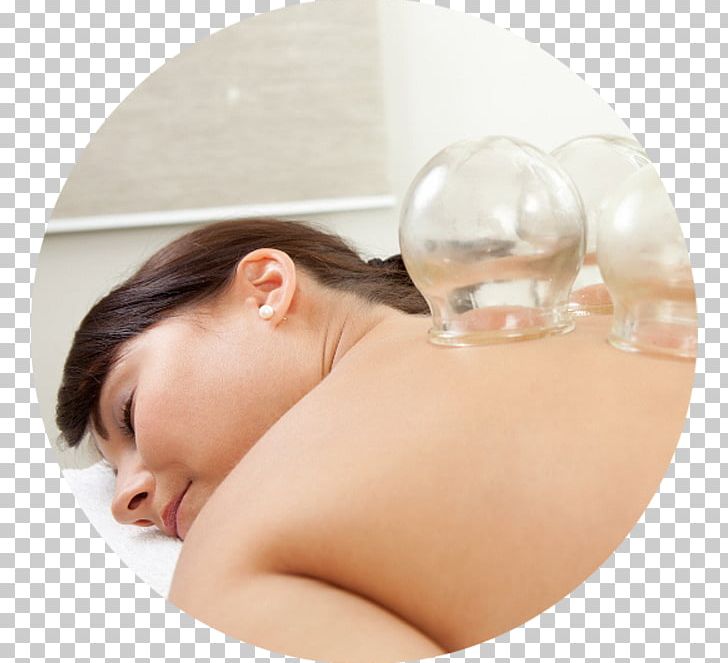 Cupping Therapy Alternative Health Services Centro Médico Jardins Massage Ventosa PNG, Clipart, Acupuncture, Alternative Health Services, Chin, Chinese, Cup Free PNG Download