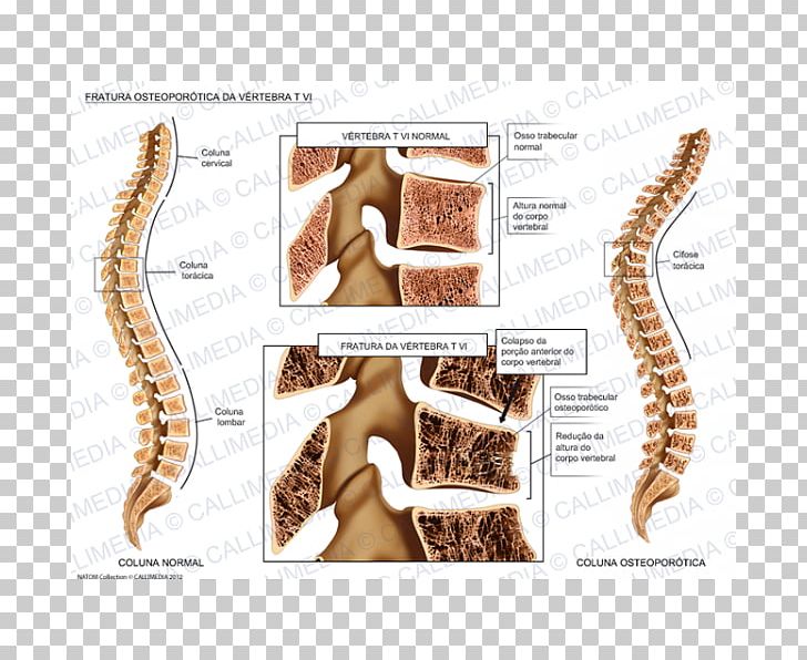 Osteoporosis Bone Fracture Vertebral Column Vertebral Compression Fracture PNG, Clipart, Anatomy, Bone, Bone Fracture, Fauna, Fracture Free PNG Download