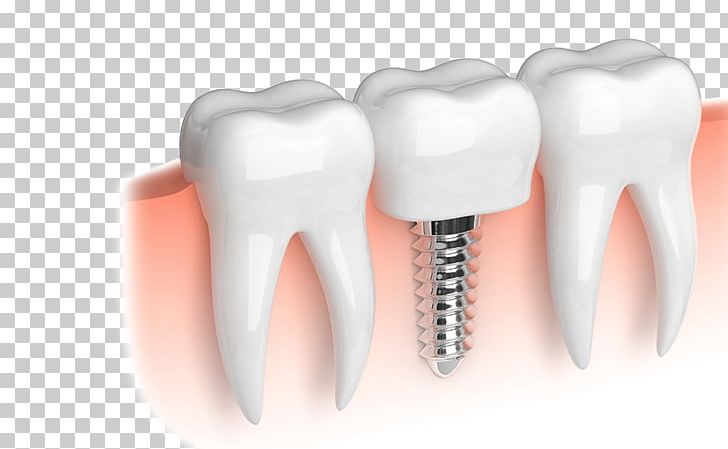 Dental Implant Dentistry Dental Restoration Dentures PNG, Clipart, Bridge, Cosmetic Dentistry, Dental Implant, Dental Public Health, Dental Restoration Free PNG Download