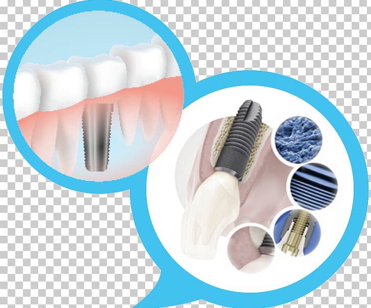 Dental Implant Dentistry OSSTEM IMPLANT PNG, Clipart, Brush, Dental Extraction, Dental Implant, Dental Implants, Dental Surgery Free PNG Download