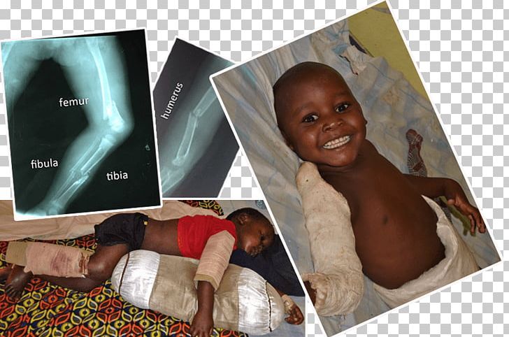 Child Tibia Bone Fracture Femur PNG, Clipart, Bone, Bone Fracture, Car, Child, Femur Free PNG Download