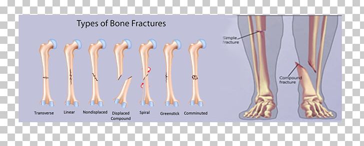 Bone Fracture Comminution Joint Pathologic Fracture PNG, Clipart, Angle, Bone, Bone Fracture, Bone Injury, Brand Free PNG Download