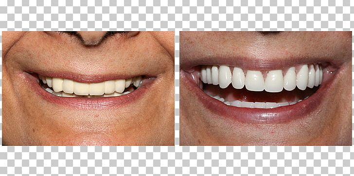 Tooth All-on-4 Dental Implant Dentures PNG, Clipart, Allon4, Cheek, Chin, Closeup, Cosmetic Dentistry Free PNG Download