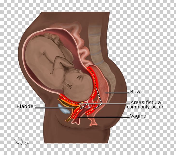 Obstetric Fistula Obstetrics Rectovaginal Fistula Childbirth PNG, Clipart, Birth Trauma, Childbirth, Ear, Fistula, Fistula Foundation Free PNG Download