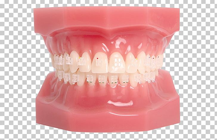 Tooth Dental Braces Orthodontics Splint Maxilla PNG, Clipart, Bruxism, Dental Braces, Jaw, Maxilla, Metalic Free PNG Download