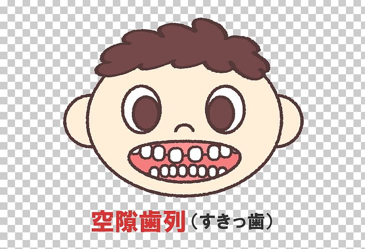 歯科 【 Muramatsu Dentistry Clinic 】 Ashiyashi Correction Shika Shinbishika Yoboshika Pediatric Dentistry Dental Braces PNG, Clipart, Area, Caption, Cheek, Crossbite, Dental Braces Free PNG Download