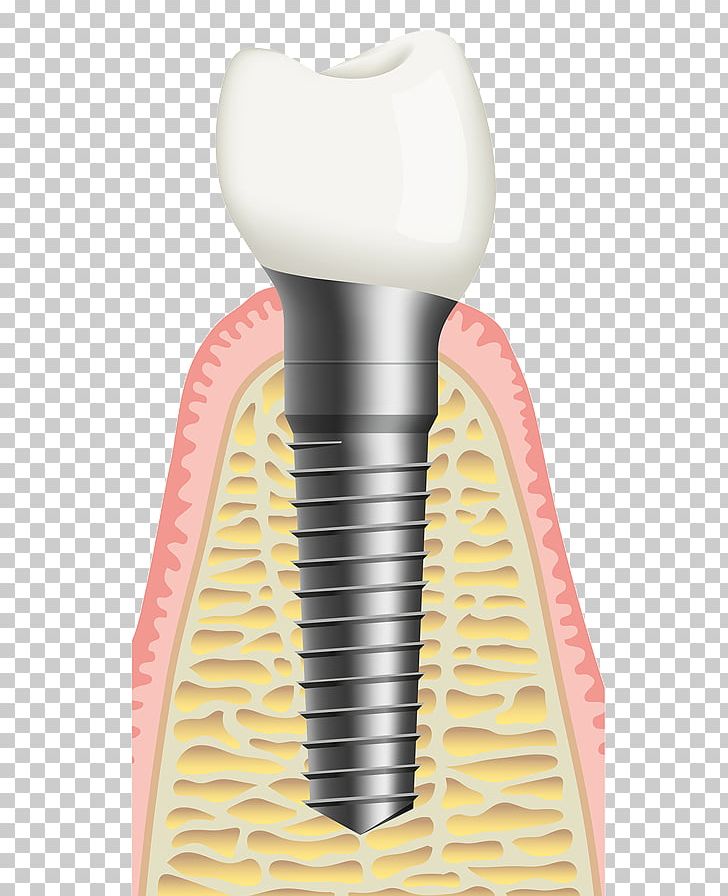 Bone Grafting Dental Implant Sinus Lift Dentist PNG, Clipart, Allon4, Bone, Bone Grafting, Brush, Crown Free PNG Download