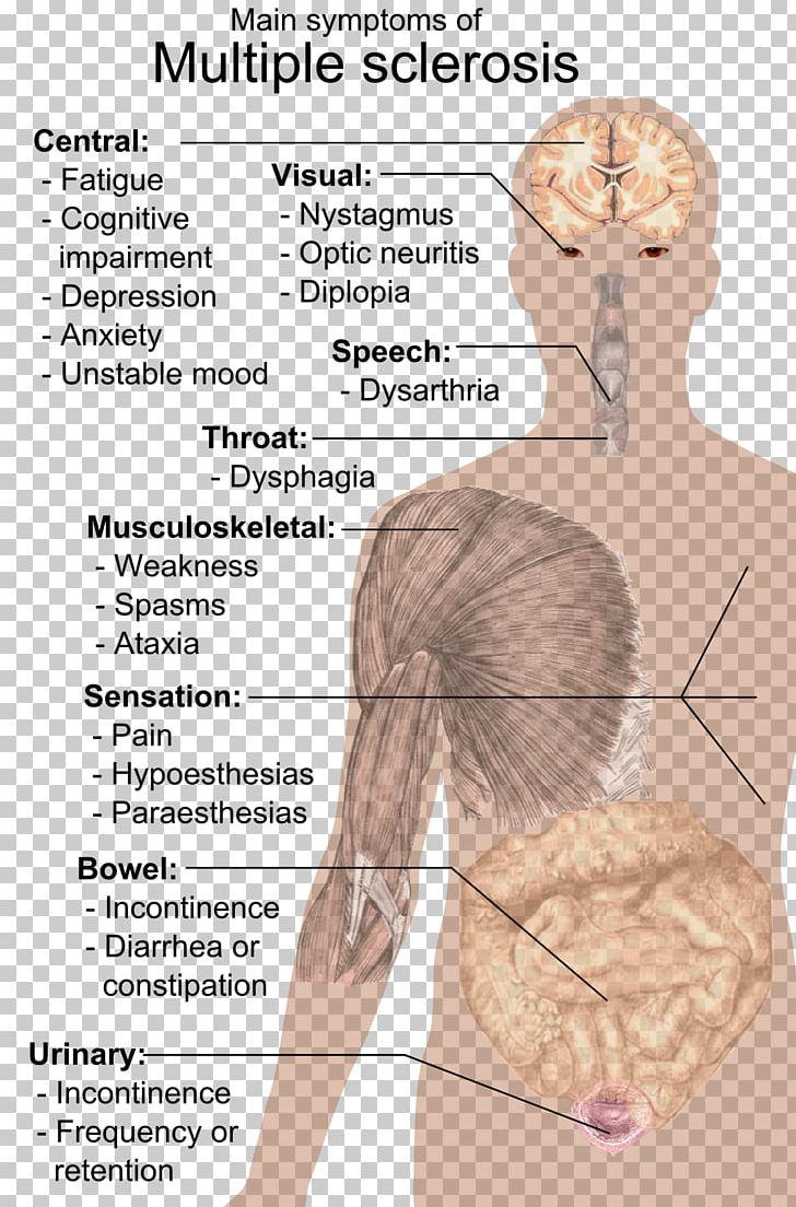 Multiple Sclerosis Signs And Symptoms Medical Sign Disease PNG, Clipart, Abdomen, Arm, Chest, Chin, Disease Free PNG Download