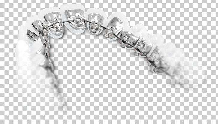 Lingual Braces Dental Braces Orthodontics Tongue Tooth PNG, Clipart, Black And White, Body Jewelry, Bracelet, Chain, Dental Braces Free PNG Download