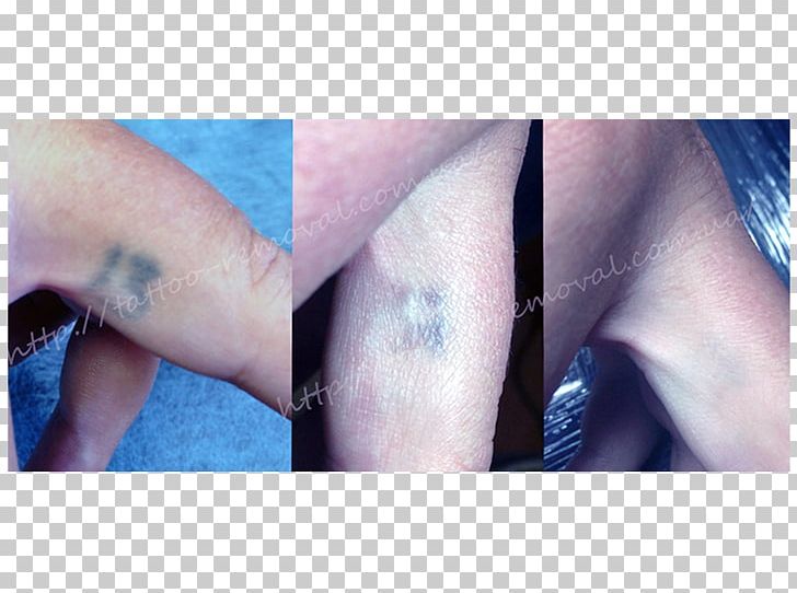 Tattoo Removal Permanent Makeup Scar Q-switching PNG, Clipart, Arm, Blue, Chin, Closeup, Disease Free PNG Download