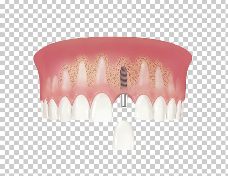 Human Tooth Dental Implant Implantology PNG, Clipart, Crown, Dental Implant, Dental Implants, Dentistry, Dentures Free PNG Download