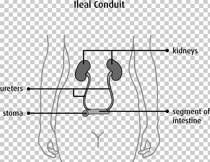 Stoma Urostomy Urinary Diversion Urine Ostomy Pouching System PNG, Clipart, Abdomen, Angle, Arm, Black And White, Blad Free PNG Download