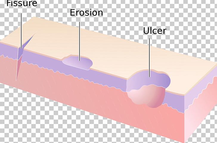 Erosion Dermatology Cutaneous Condition Skin Fissure Skin Ulcer PNG, Clipart, Anal Fissure And Fistula, Angle, Cutaneous Condition, Dermatology, Dermis Free PNG Download