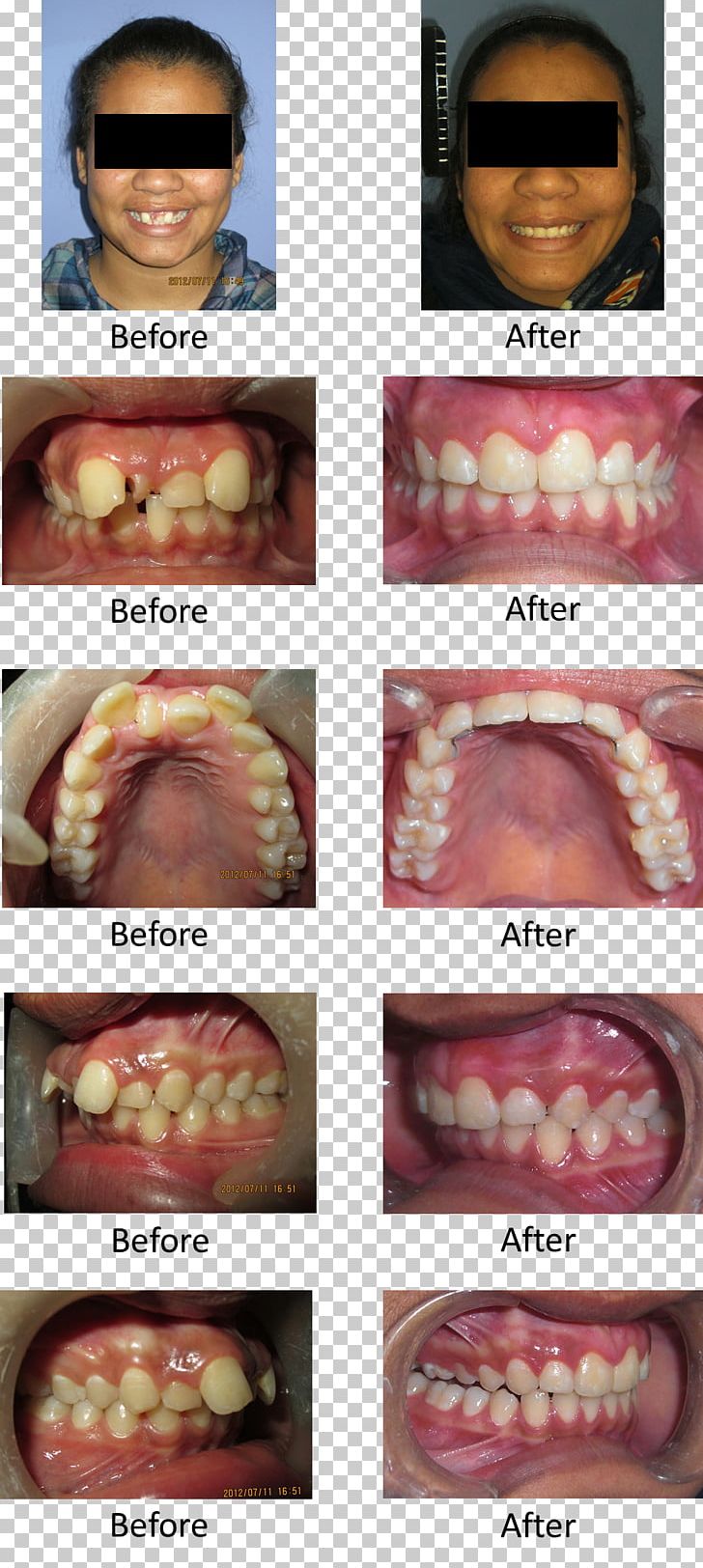 Hyperdontia Human Tooth Molar Disease PNG, Clipart, Cause, Cheek, Chin, Crown, Diastema Free PNG Download