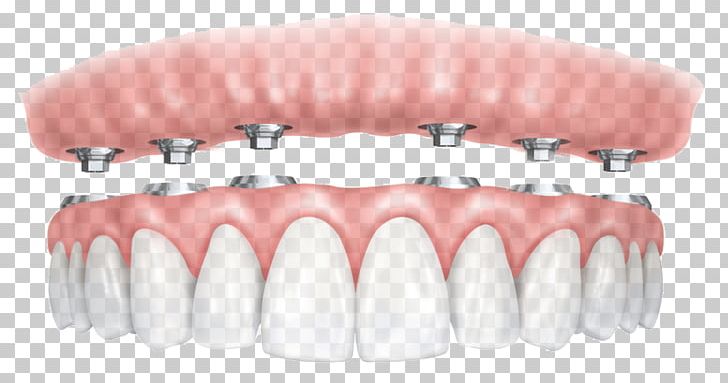 All-on-4 Dental Implant Dentures Dentistry PNG, Clipart, Allon4, Attache, Ball, Dental Implant, Dental Restoration Free PNG Download