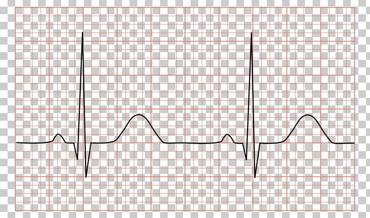 Electrocardiography QRS Complex Sinus Rhythm Heart Arrhythmia PNG, Clipart, Angle, Area, Atrium, Cardiac Muscle, Cardiology Free PNG Download