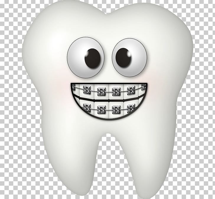 Dental Braces Dentistry Tooth PNG, Clipart, Bone, Clip Art, Cosmetic Dentistry, Dental Braces, Dental Implant Free PNG Download