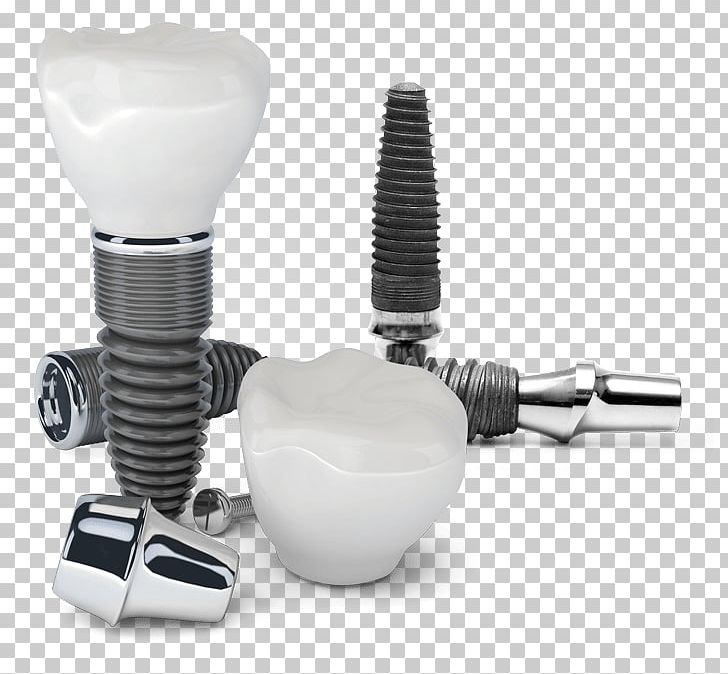 Dental Implant Cosmetic Dentistry PNG, Clipart, Clinic, Cosmetic Dentistry, Crown, Dental Implant, Dental Surgery Free PNG Download