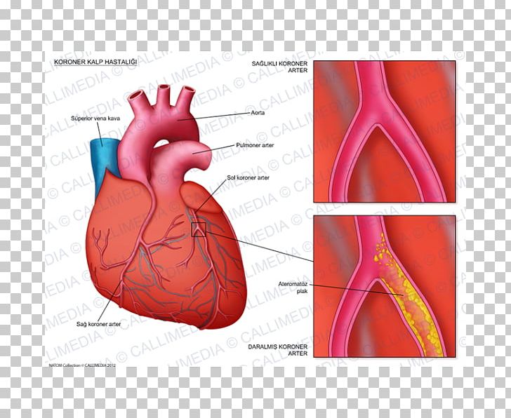 Coronary Artery Disease Coronary Arteries Cardiology Cardiovascular Disease PNG, Clipart, Artery, Atheroma, Blood Vessel, Cardiology, Cardiovascular Disease Free PNG Download