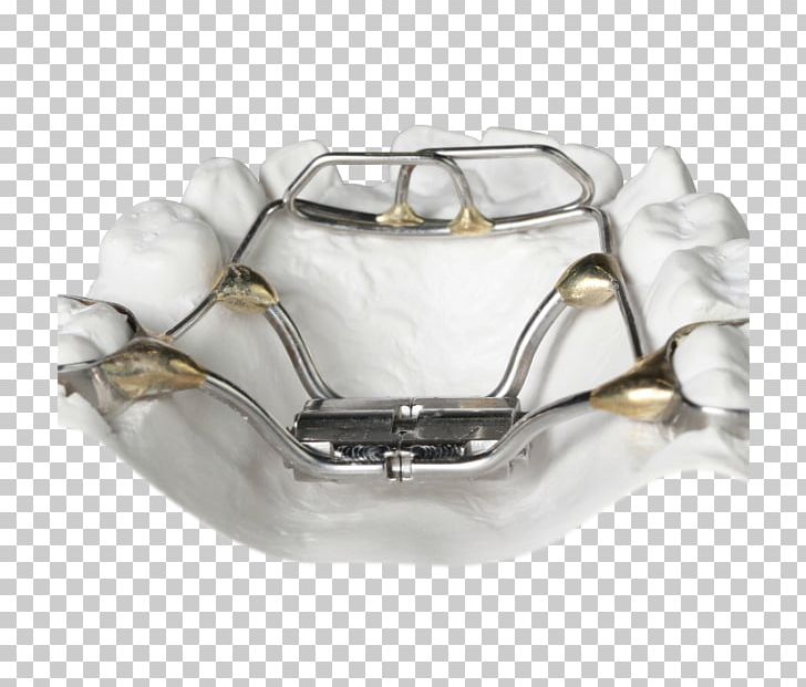 Orthodontics Palatal Expansion Cots Retainer Tongue PNG, Clipart, Bionator, Clear Aligners, Dental, Dentistry, Fashion Accessory Free PNG Download