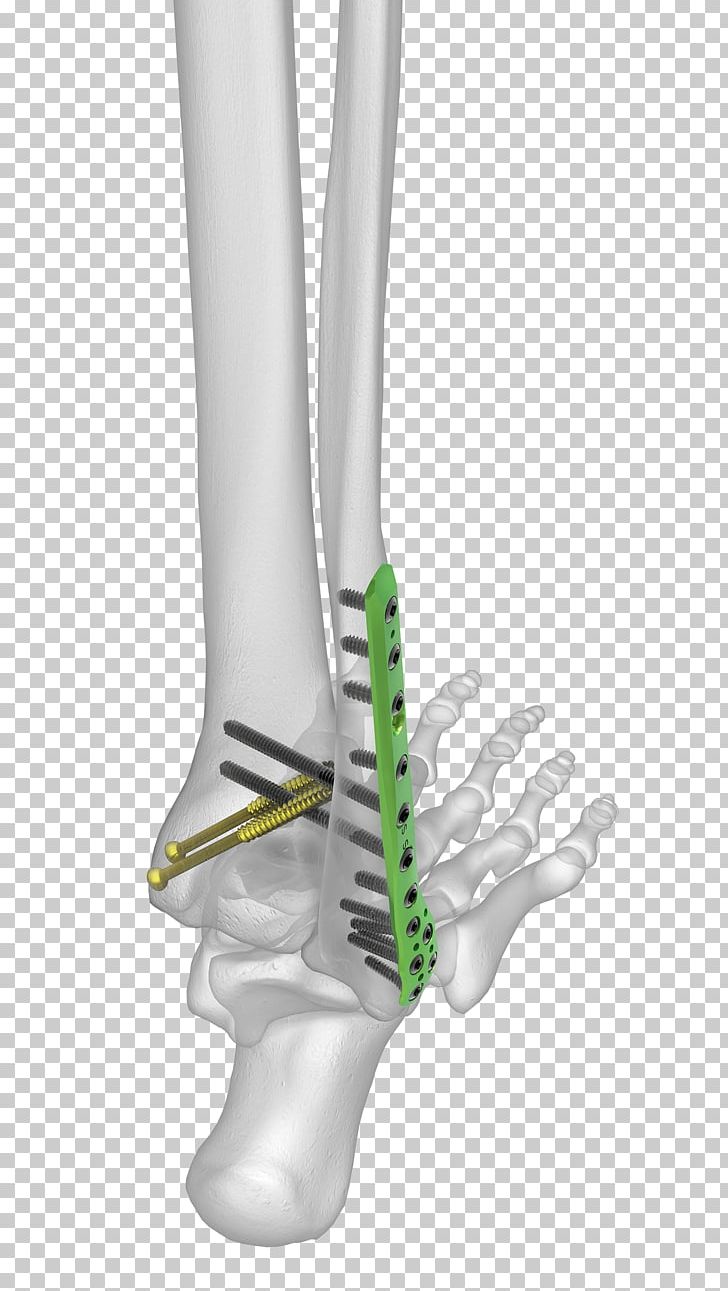 Fibula Human Leg Ankle Fracture Malleolus PNG, Clipart, Ankle, Ankle Fracture, Arm, Arthrodesis, Avulsion Fracture Free PNG Download