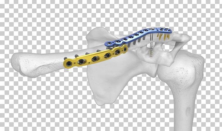 Clavicle Fracture Shoulder Bone Fracture Salter–Harris Fracture PNG, Clipart, Acu, Anterior, Bone, Bone Fracture, Clavicle Free PNG Download