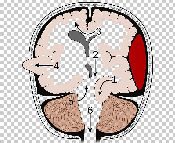 Brain Herniation Intracranial Pressure Traumatic Brain Injury Cerebellar Tentorium PNG, Clipart, Area, Brain, Brain Haemorrhage, Brain Herniation, Brainstem Free PNG Download