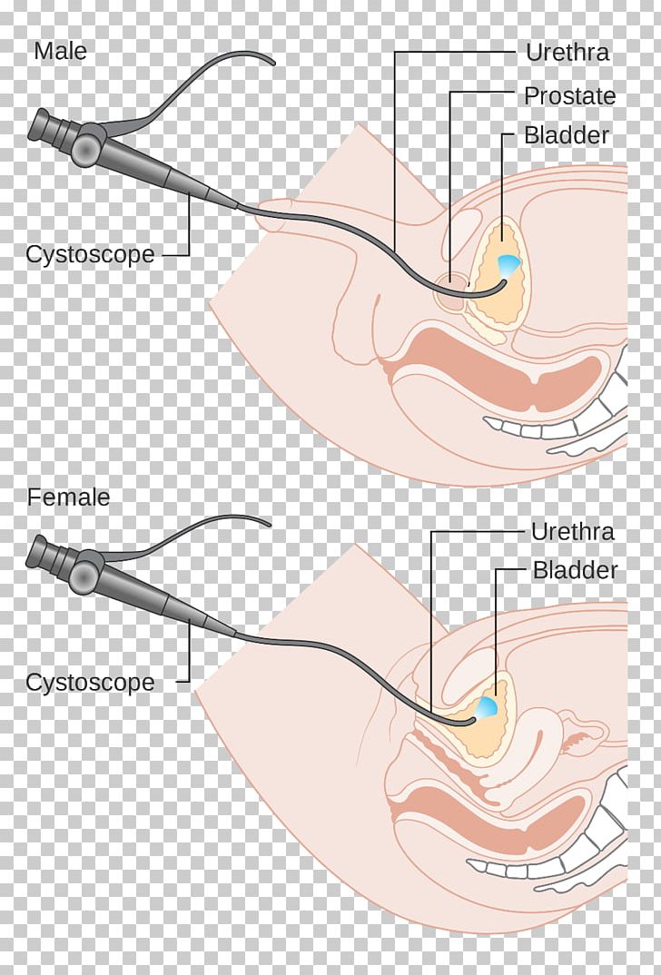 Cystoscopy Ureteroscopy Endoscopy Medical Procedure Surgery PNG, Clipart, Abdomen, Angle, Arm, Bladder, Cystoscopy Free PNG Download