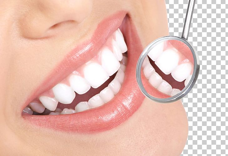Tooth Whitening Tooth Decay Therapy Dentist PNG, Clipart, Cheek, Chin, Cosmetic Dentistry, Crown, Dental Bonding Free PNG Download