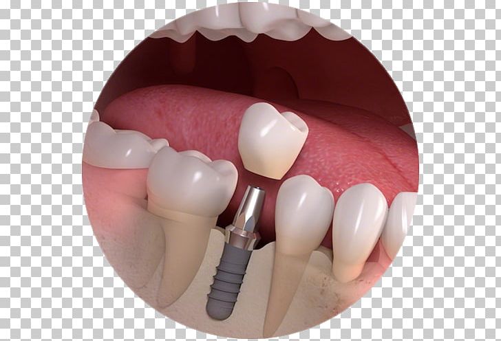 Dental Implant Dentistry Bridge PNG, Clipart, Allon4, Bridge, Cosmetic Dentistry, Crown, Dental Implant Free PNG Download