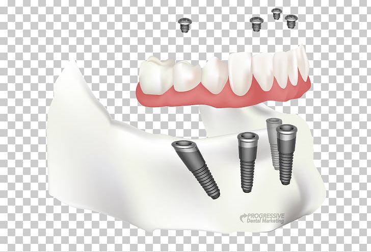Tooth Dental Implant Dentistry All-on-4 PNG, Clipart, Allon4, All On 4, Dental Implant, Dental Restoration, Dental Surgery Free PNG Download