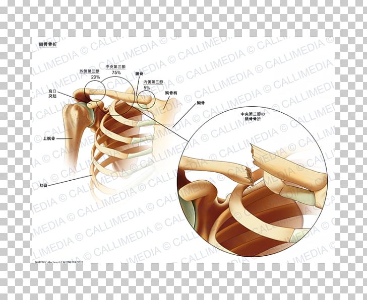 Clavicle Fracture Bone Fracture Sternum PNG, Clipart, Arm, Bone, Bone Fracture, Clavicle, Clavicle Fracture Free PNG Download