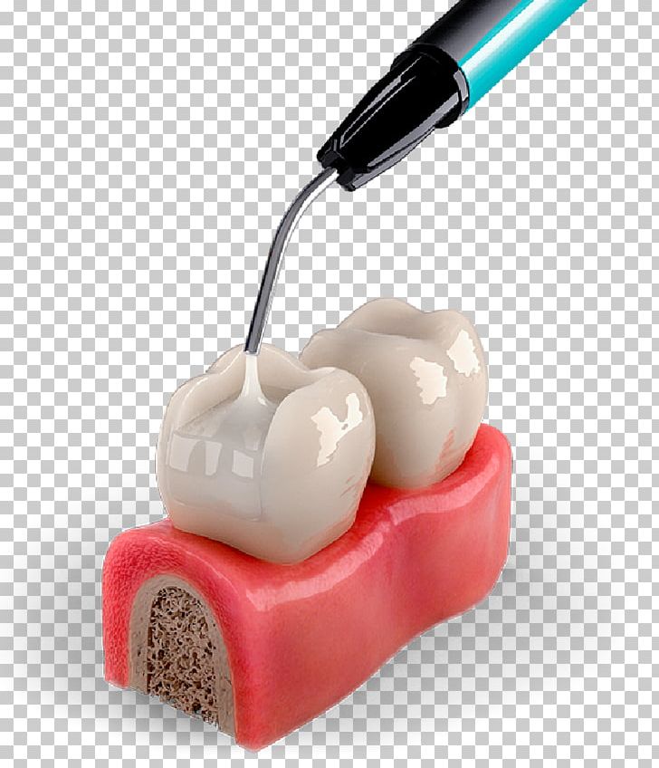 Tooth Decay Dentistry Neck PNG, Clipart, Abdominal Pain, Canine Tooth, Dental Braces, Dental Material, Dentist Free PNG Download